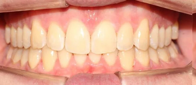 Установка ретейнеров на нижнюю и верхнюю челюсть