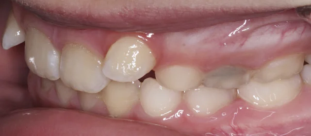 Исправление сменного прикуса подростку