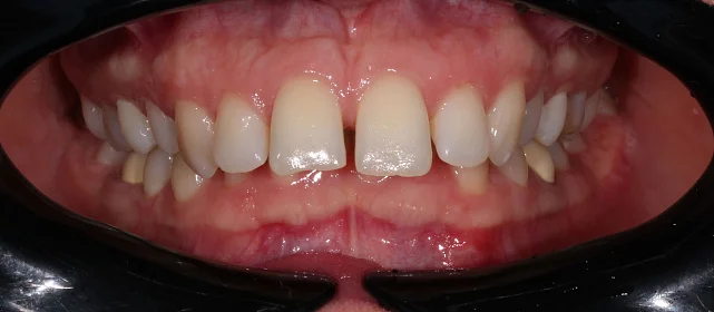 Смещение клыков и моляров по 2 классу по Энглу справа и слева