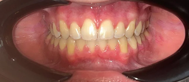 Ортодонтическое лечение на брекет-системе №4