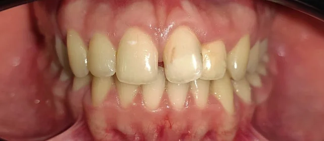 Лечение на брекет-системе