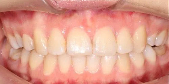 Ортодонтическое лечение на брекет-системе