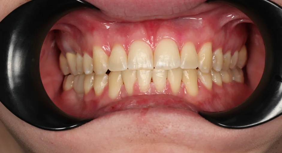 Лечение аномалии соотношений зубных дуг на брекет-системе