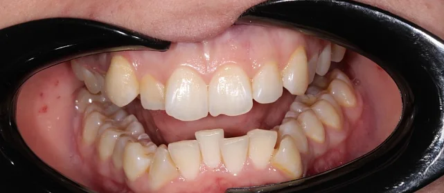 Лечение аномалии соотношения зубных дуг элайнерами