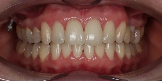 Лечение аномалии соотношения зубных дуг элайнерами