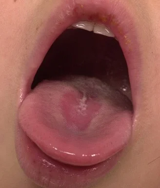 ромбовидный глоссит фото