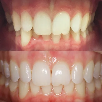 Лечение ретрузионного наклона верхних резцов с последующей реставрацией