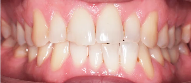 Исправление прикуса и имплантация