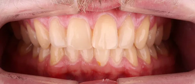 Ортодонтическое лечение на системе Click №3