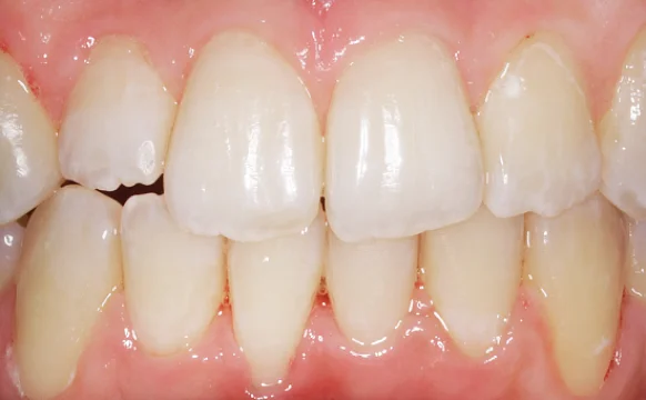 Завершающий этап лечения скученности и обратного перекрытия