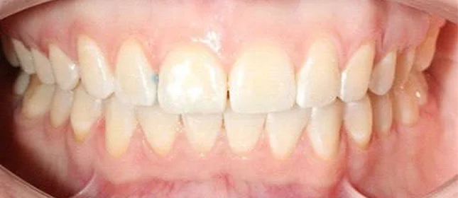 Коррекция дистального прикуса элайнерами