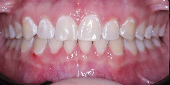 Лечение диастемы на верхней челюсти на элайнерах Click