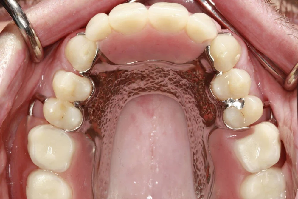 бюгельный протез отзывы