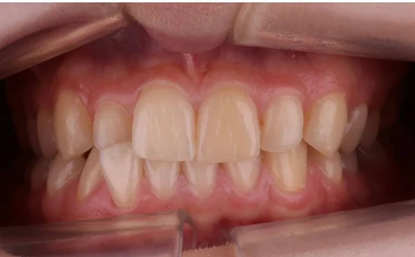 Ортодонтическое лечение на системе Click