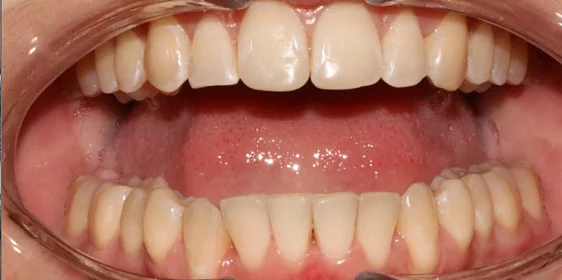 Лечение аномалии соотношения зубных дуг элайнерами