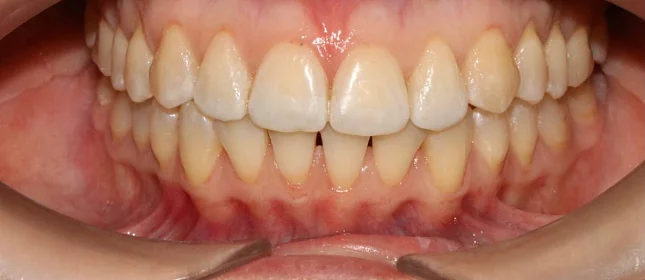 Лечение скученности зубов элайнерами