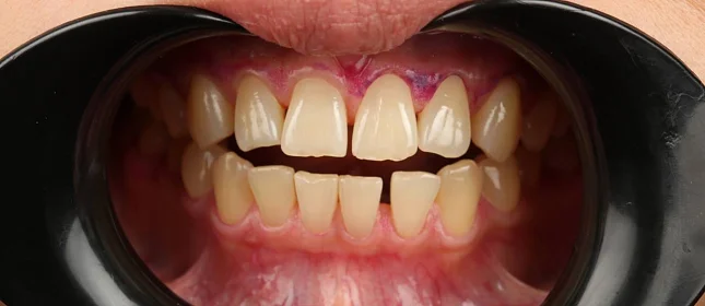 Ортодонтическое лечение на элайнерах №10