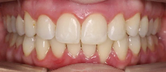 Лечение скученности зубов на элайнерах