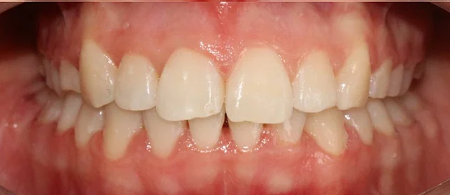 Ортодонтическое лечение нa брекет-системе