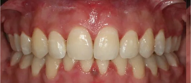 Ортодонтическое лечение на брекет-системе №2