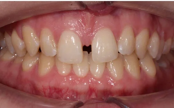 Ортодонтическое лечение на элайнерах