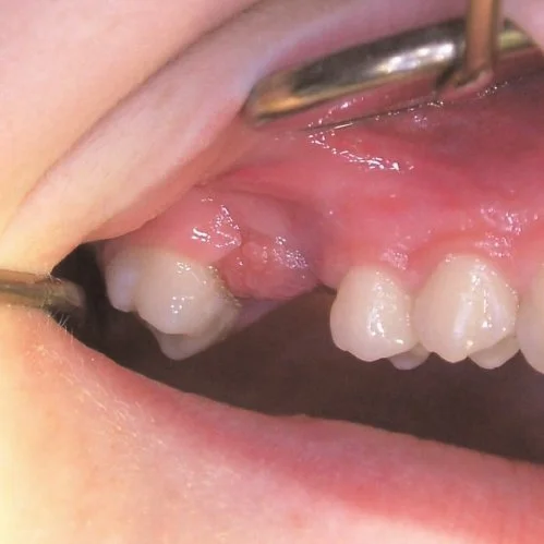 киста гранулема зуба