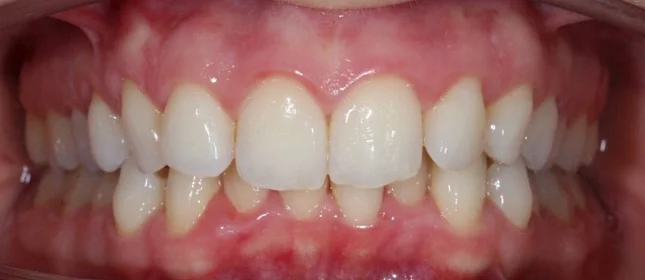 Лечение скученности зубов на элайнерах