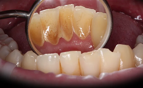 Удаление камней и профессиональная гигиена для последующего лечения кариеса