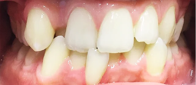 Завершающий этап лечения скученности и обратного перекрытия