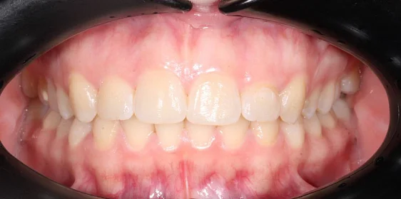 Лечение cкученности на нижней челюсти на элайнерах