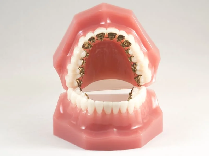 установка лингвальных брекетов - изображение 1