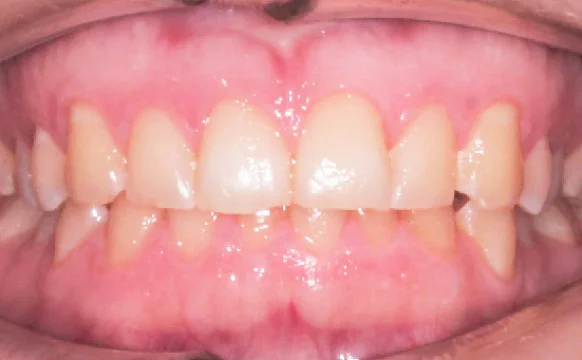 Исправление прикуса. 17 кап, 9 месяцев лечения