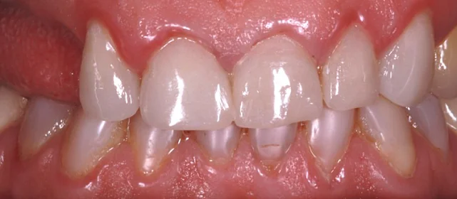 Протезирование верхнего и нижнего ряда, установка виниров