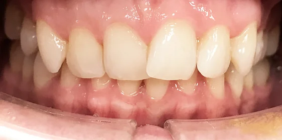 Исправление глубокого перекрытия зубов без брекетов