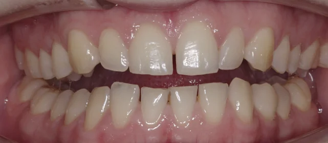 Лечение дистального прикуса