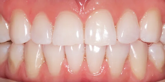 Исправление прикуса элайнерами Инвизилайн
