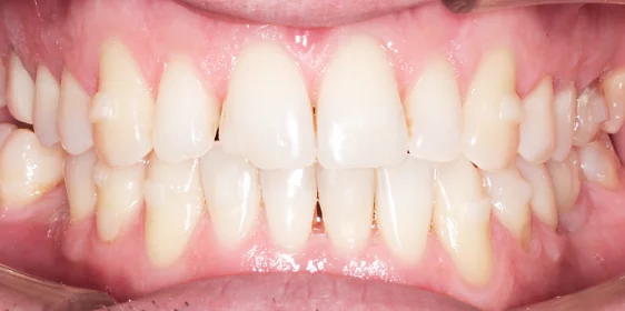 Исправление прикуса и имплантация