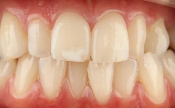 Коррекция аномалии положения зубов на элайнерах