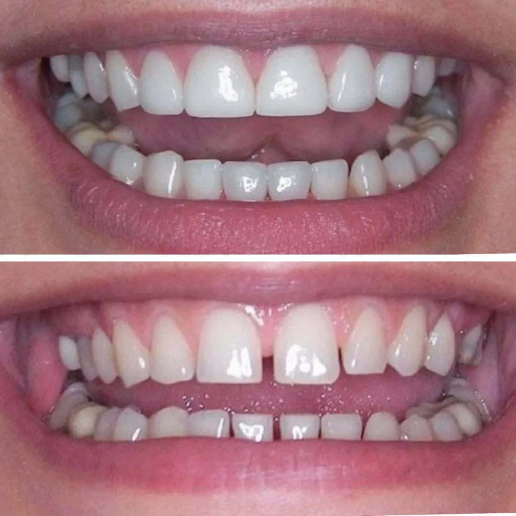 лечение винирами