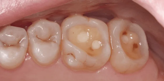 Восстановление эстетики с помощью виниров и вкладок (часть 2)