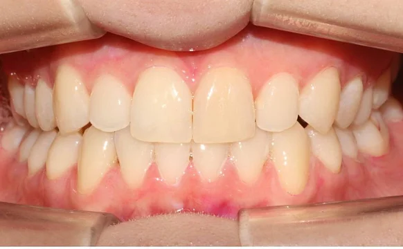 Ортодонтическое лечение на системе Click