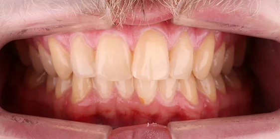 Ортодонтическое лечение на системе Click