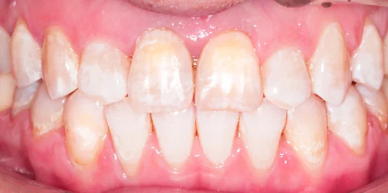 Исправление прикуса. 38 кап, 19 месяцев лечения