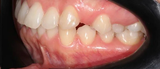 Ортодонтическое лечение на системе Click №1