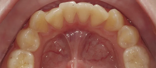 Лечение скученности зубов элайнерами