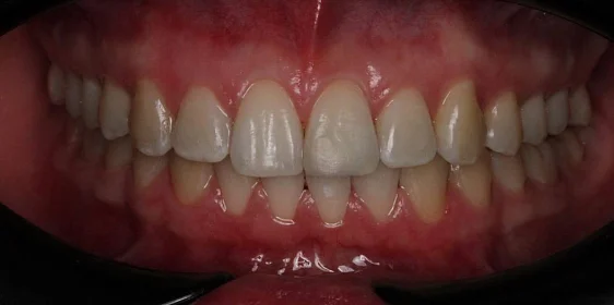 Лечение дистальной окклюзии на брекет-системе