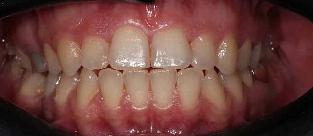 Лечение аномалии соотношений зубных дуг на элайнерах