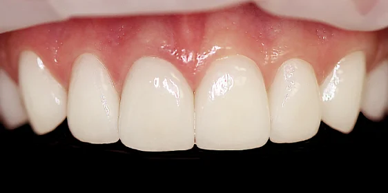 Улучшение эстетики верхних зубов после ортодонтического лечения
