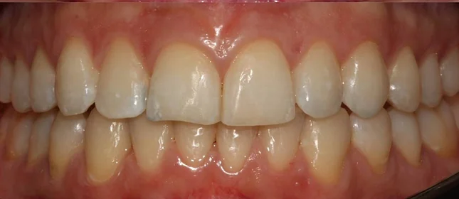 Ортодонтическое лечение на элайнерах №7