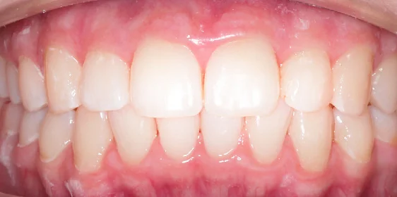 Лечение скученности зубов капами Инвизилайн